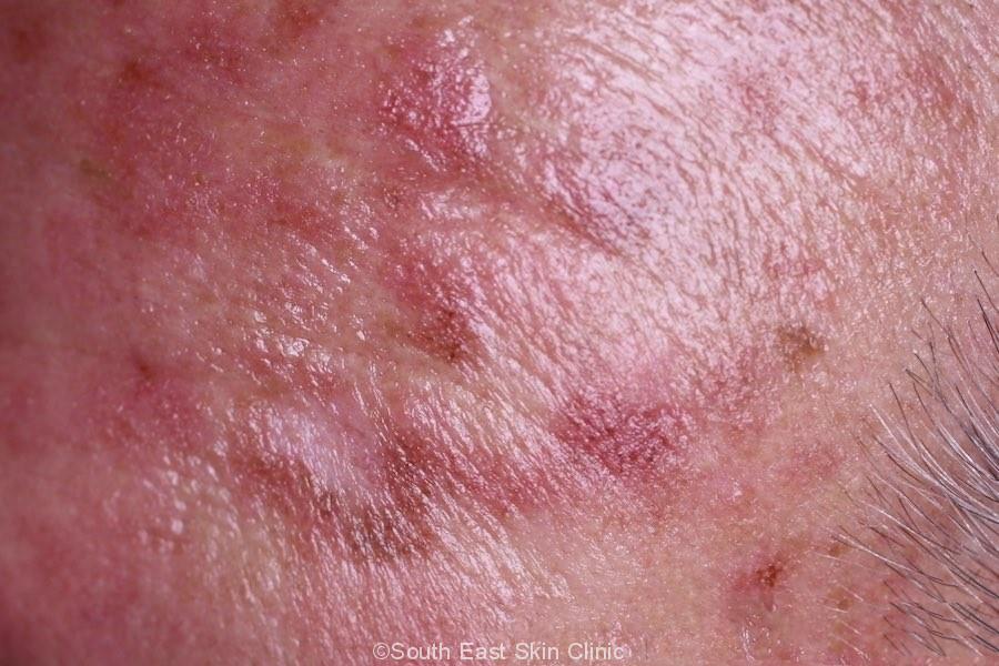 Efudex Treatment Face Doctor Heck