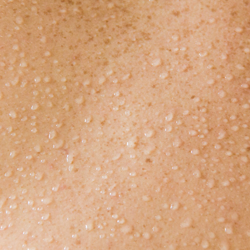 Excessive Sweating SKIN Clinics