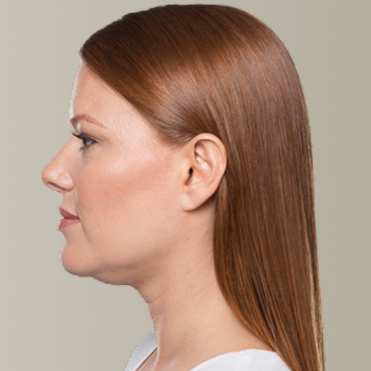 Fat Dissolving Injections SkinLab