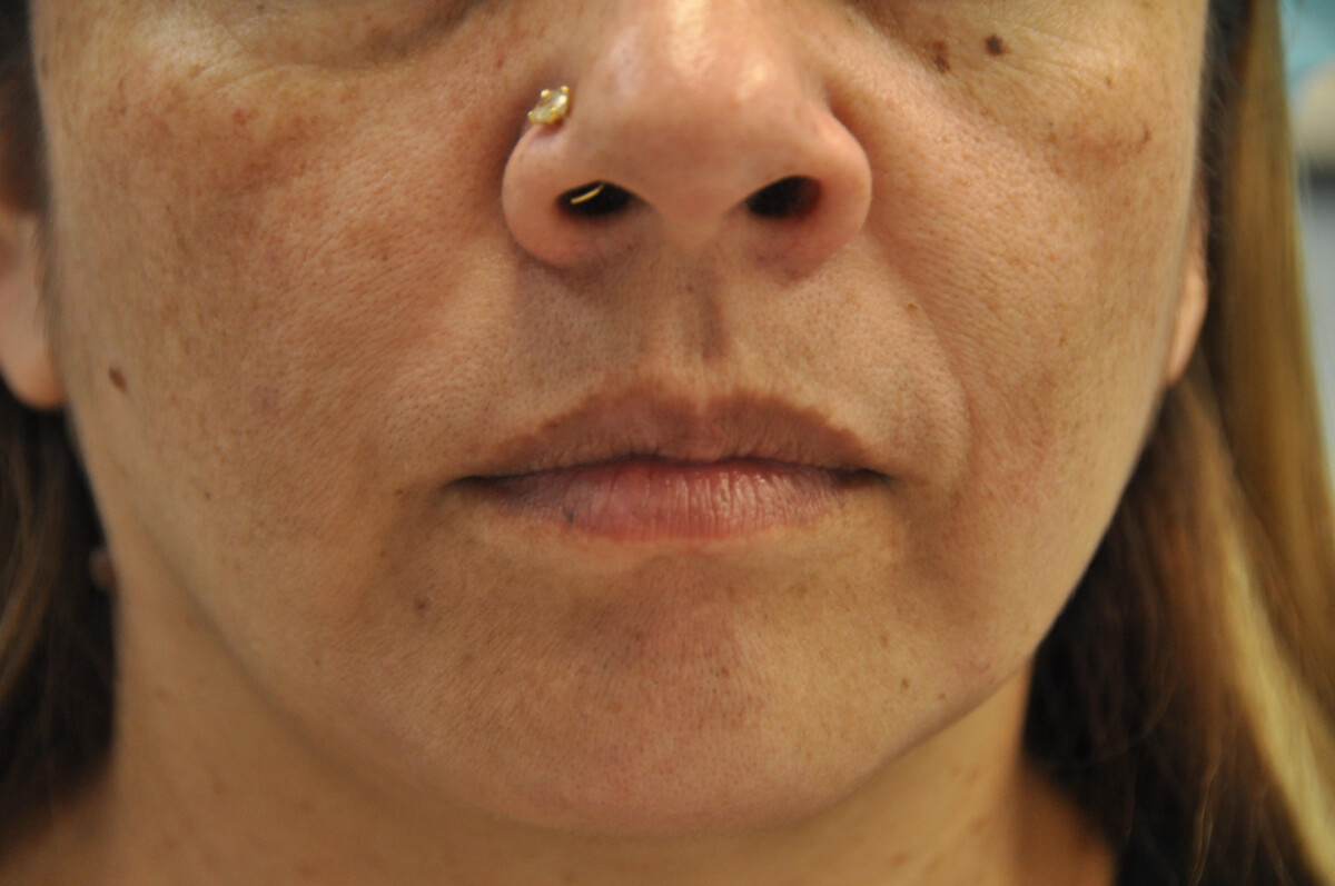 Melasma / Pregnancy Mask Skin & Laser Surgery Center of New England