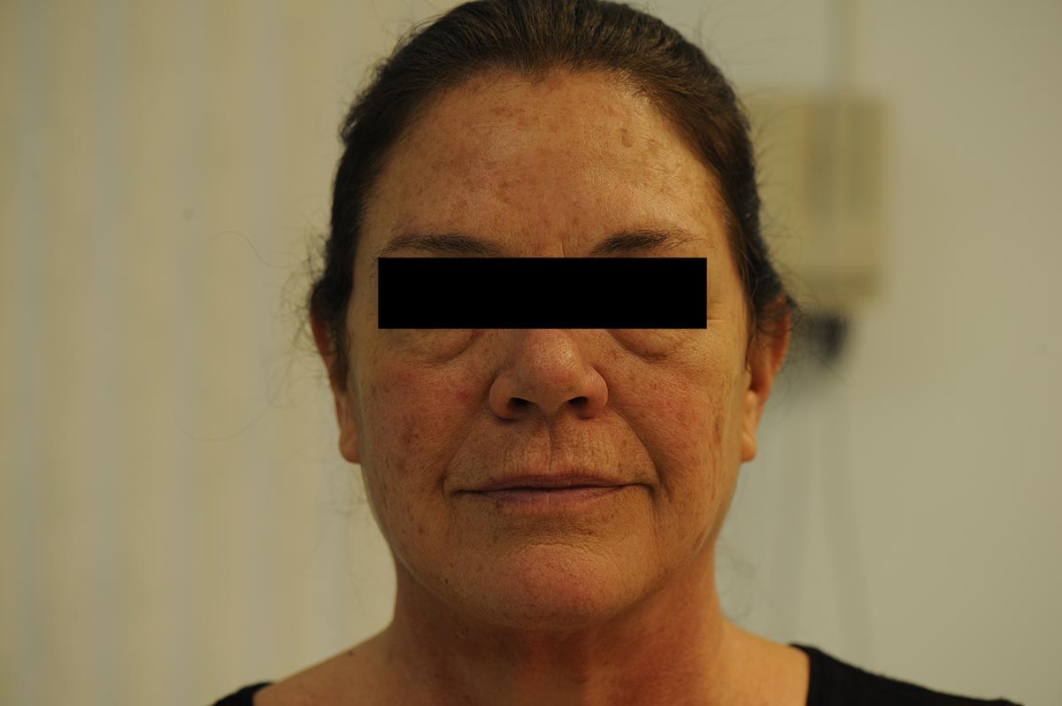 CO2 Laser Skin Resurfacing Treatment Skin & Laser Surgery Center of