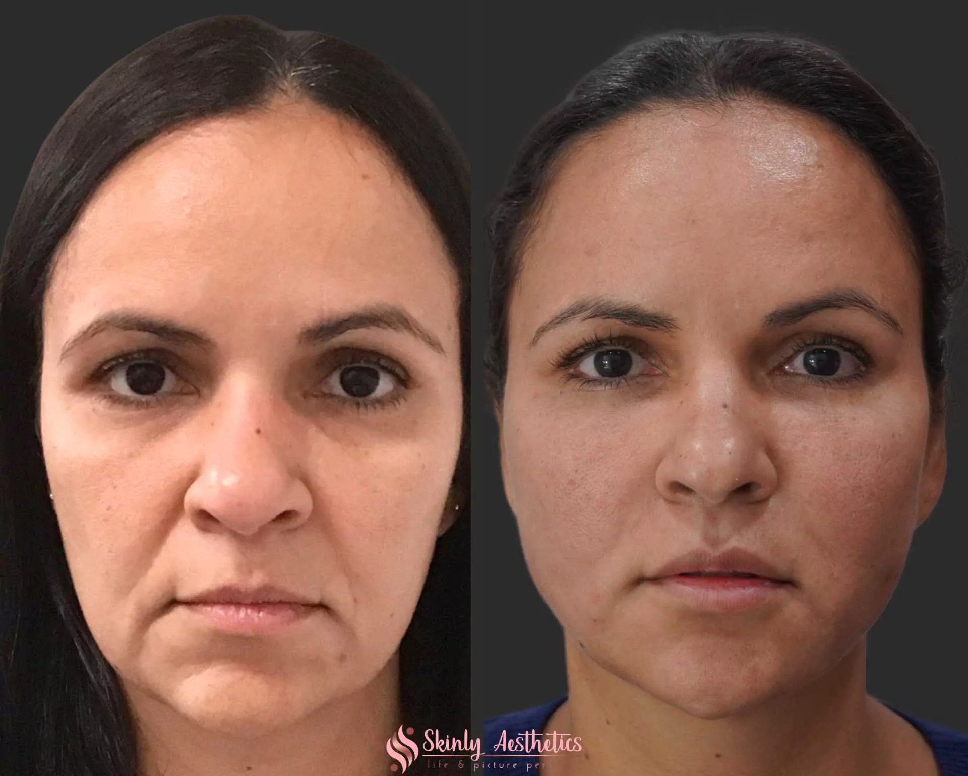 PDO Thread Lift Nonsurgical facelift Skinly Aesthetics