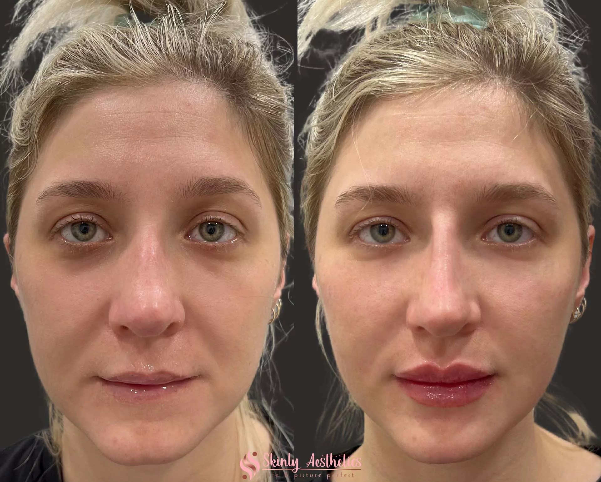 Under Eye Fillers Before & After Results at Skinly(03)