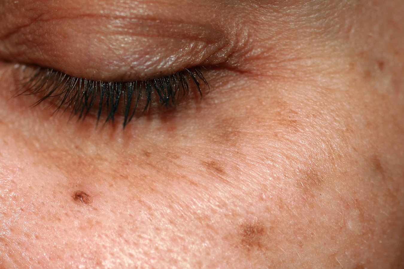 Age Spots & Treatments Skin MD Laser & Cosmetic Group