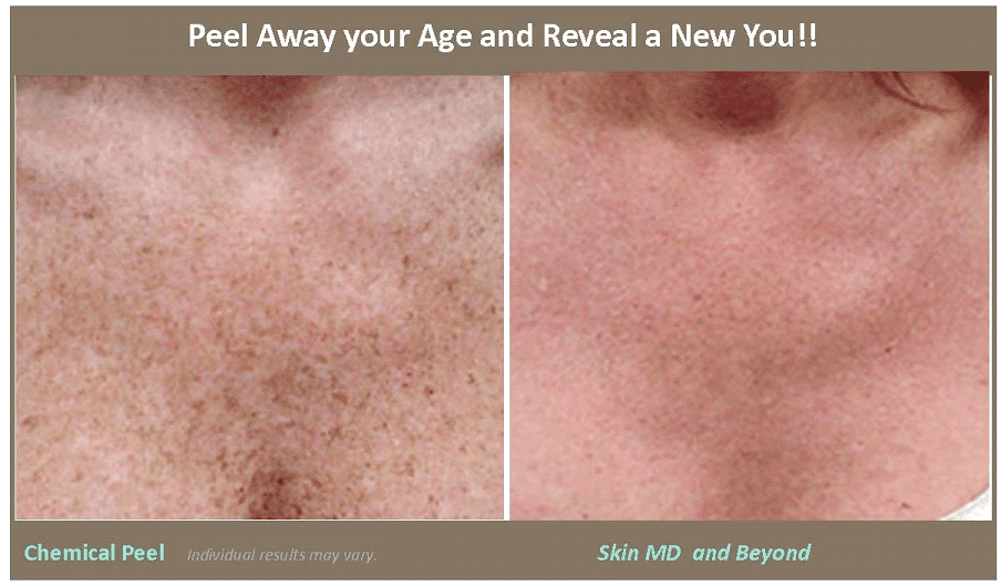 Cheek Rejuvenation Plano TX Skin MD & Beyond