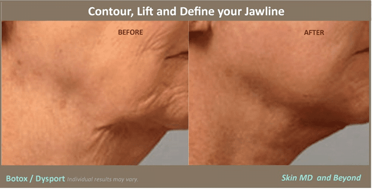 Botox Plano TX Botox Injection Frisco TX Botox Treatment