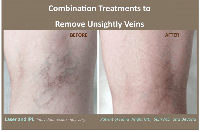 Using Lasers to treat Varicose and Spider Veins BUTEX Medical spa and Laser treatment