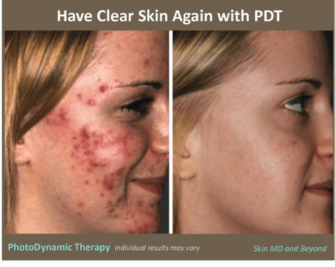 Blue Light Photodynamic Therapy For Acne Reviews Shelly Lighting