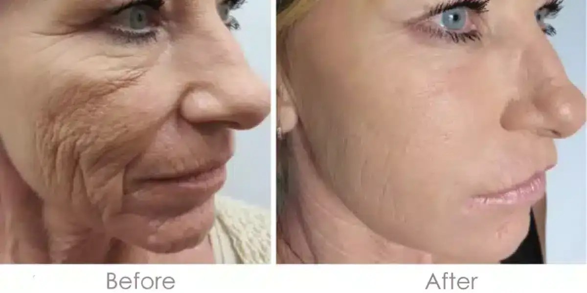 Microneedling Before And After Real Patient Results SKINNEY Medspa
