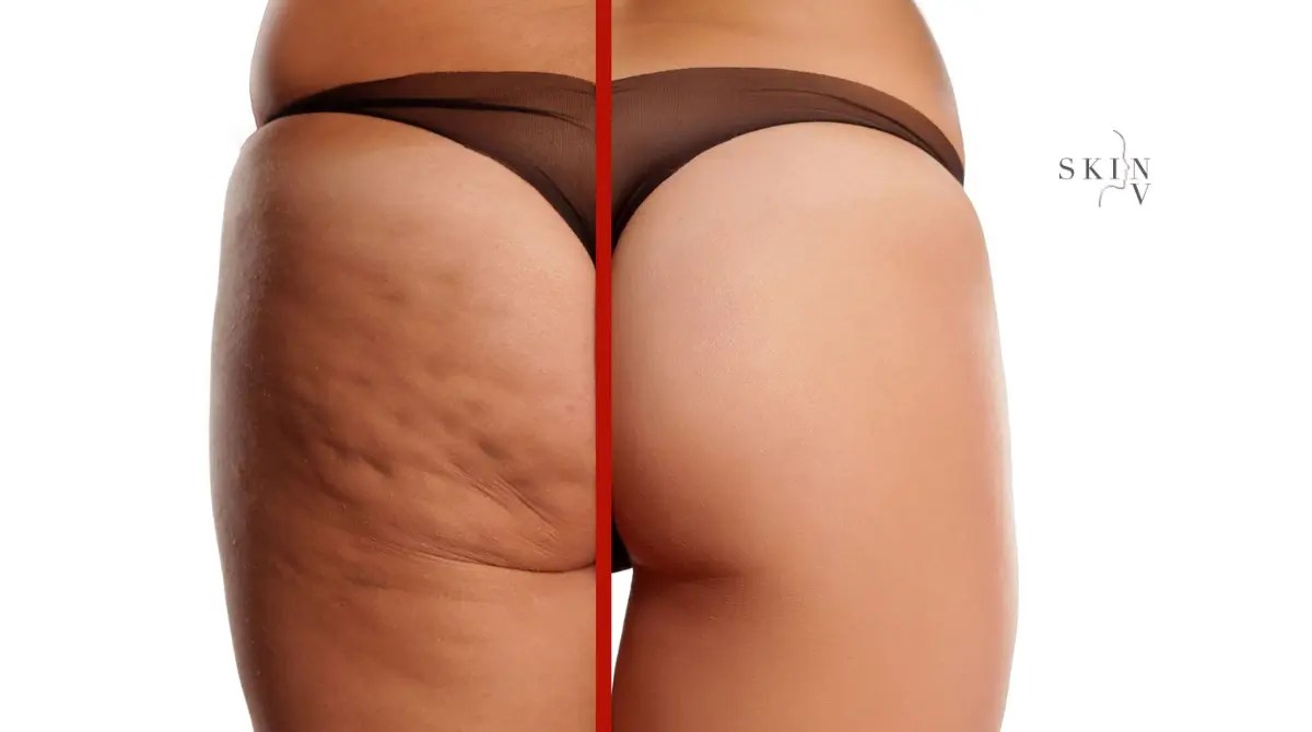 The Truth About Cellulite Causes & Prevention Skin NV Clinic