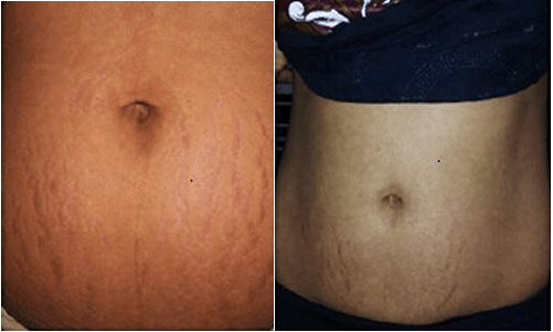 Best Stretch Mark Removal Creams of 2020 [Clinically tested] SkinPractice