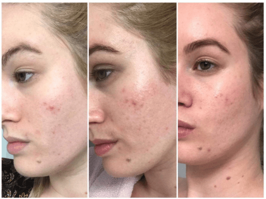 The Best Scar Creams Of 2020 Clinically Tested