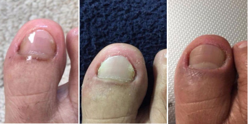Kerasal Nail Before And After - Nail Ftempo