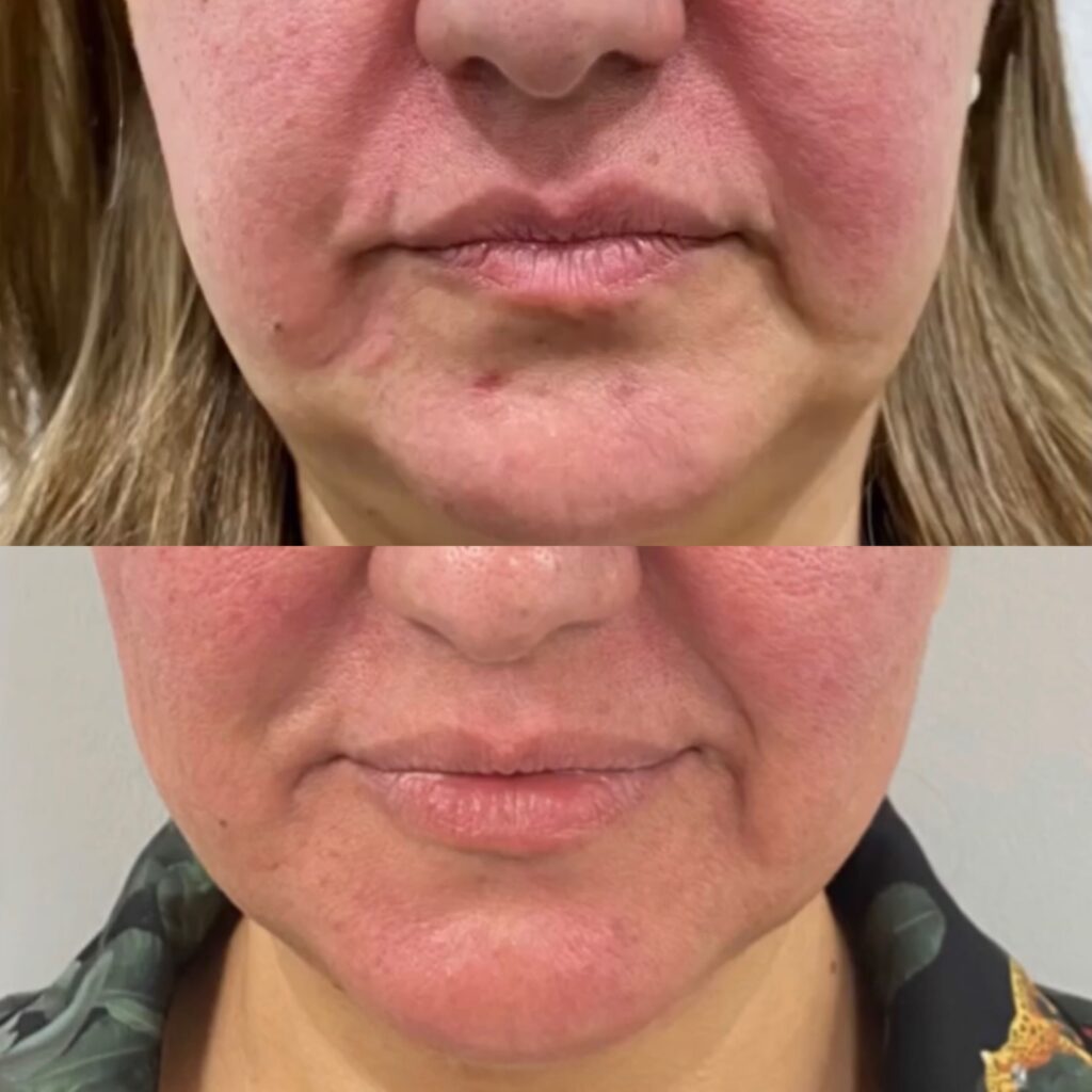 Morpheus8 Lasers Los Angeles Skin Tightening, Botox and Lip Fillers