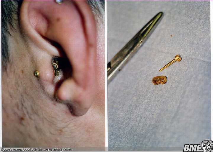 Piercing Gun Gone Wrong lupon.gov.ph