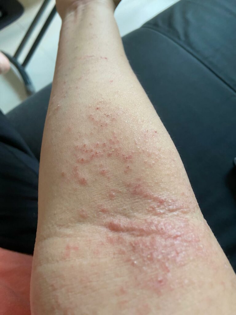 These Eczema Sleeves Stopped Me from Scratching My Arms to Shreds SkinshareSG