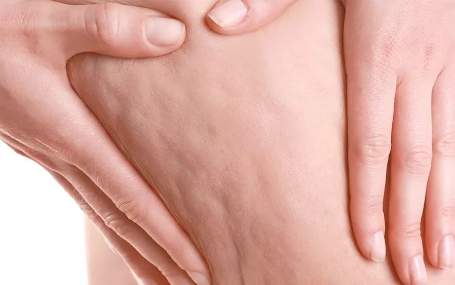 Cellulite Facts Skin Snobs