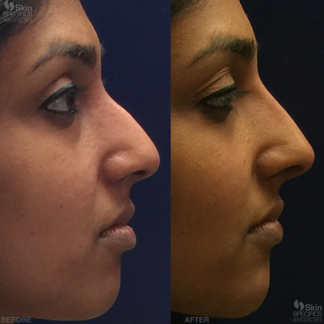 Medical Spa West LA & La Cañada Flintridge Skin Specifics nose and
