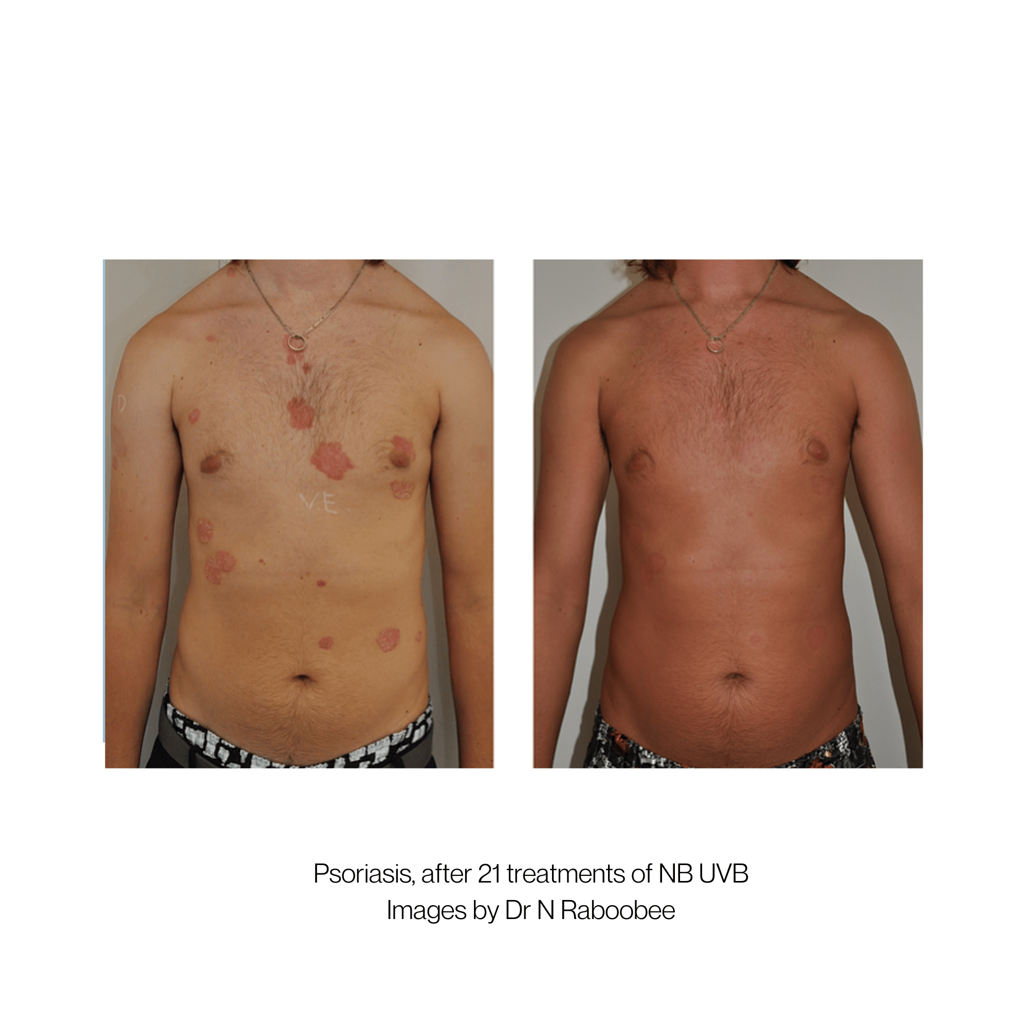 Daavlin UV Series - Skintech