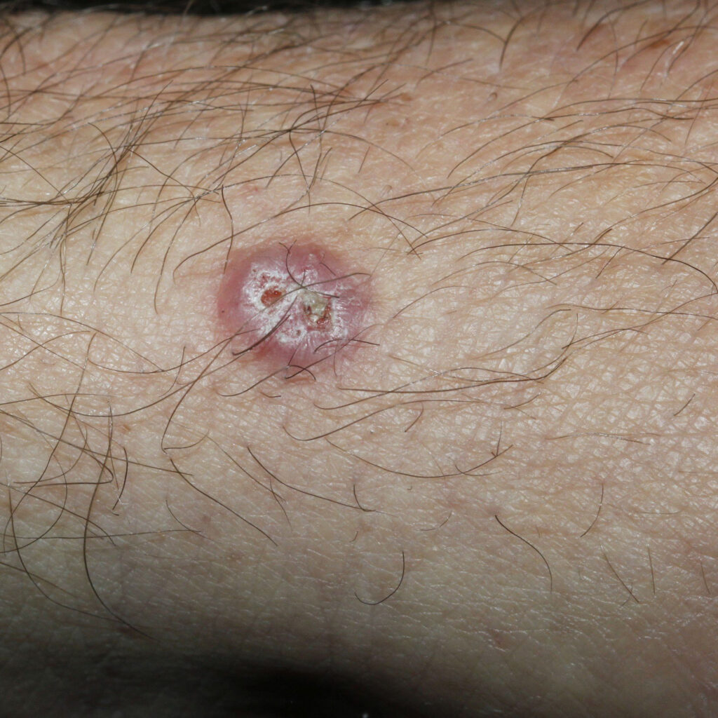 Basal Cell Carcinoma The Definitive Guide Skintel