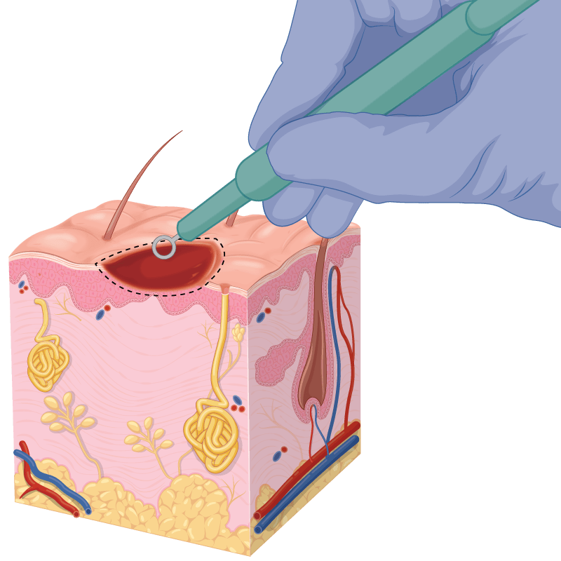 Skin Biopsy Specialists Auckland, NZ Skintel