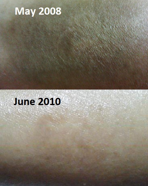 How castor oil healed my scar (with before and after photos) SKINVERSE