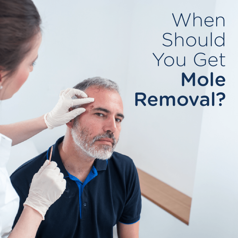 When Should You Get Mole Removal? Skin Wellness Dermatology
