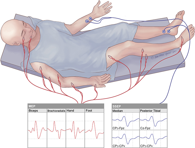 INTRAOPERATIVE NEUROMONITORING Bi Lab