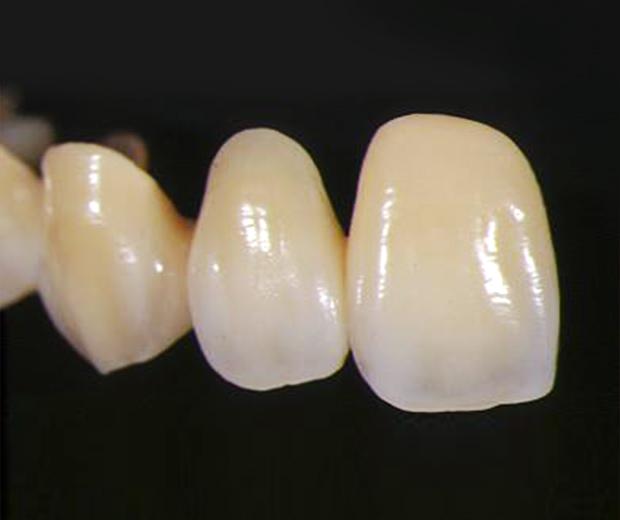 Crown & Bridge PFM & Gold Crown