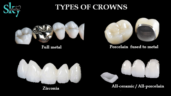 Types of Crowns Sky Dental