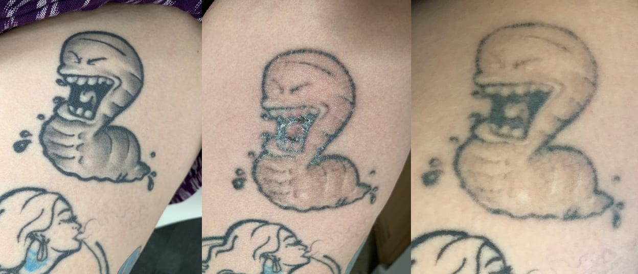 My Laser Tattoo Removal Journey SKYN® Perth