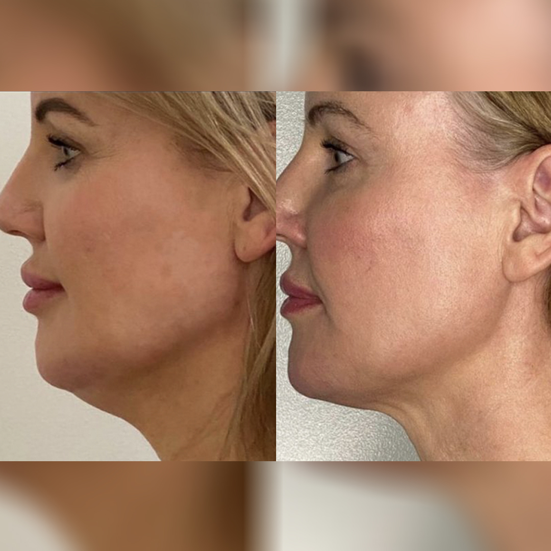 PDO COG Thread Lift SKYN® Perth