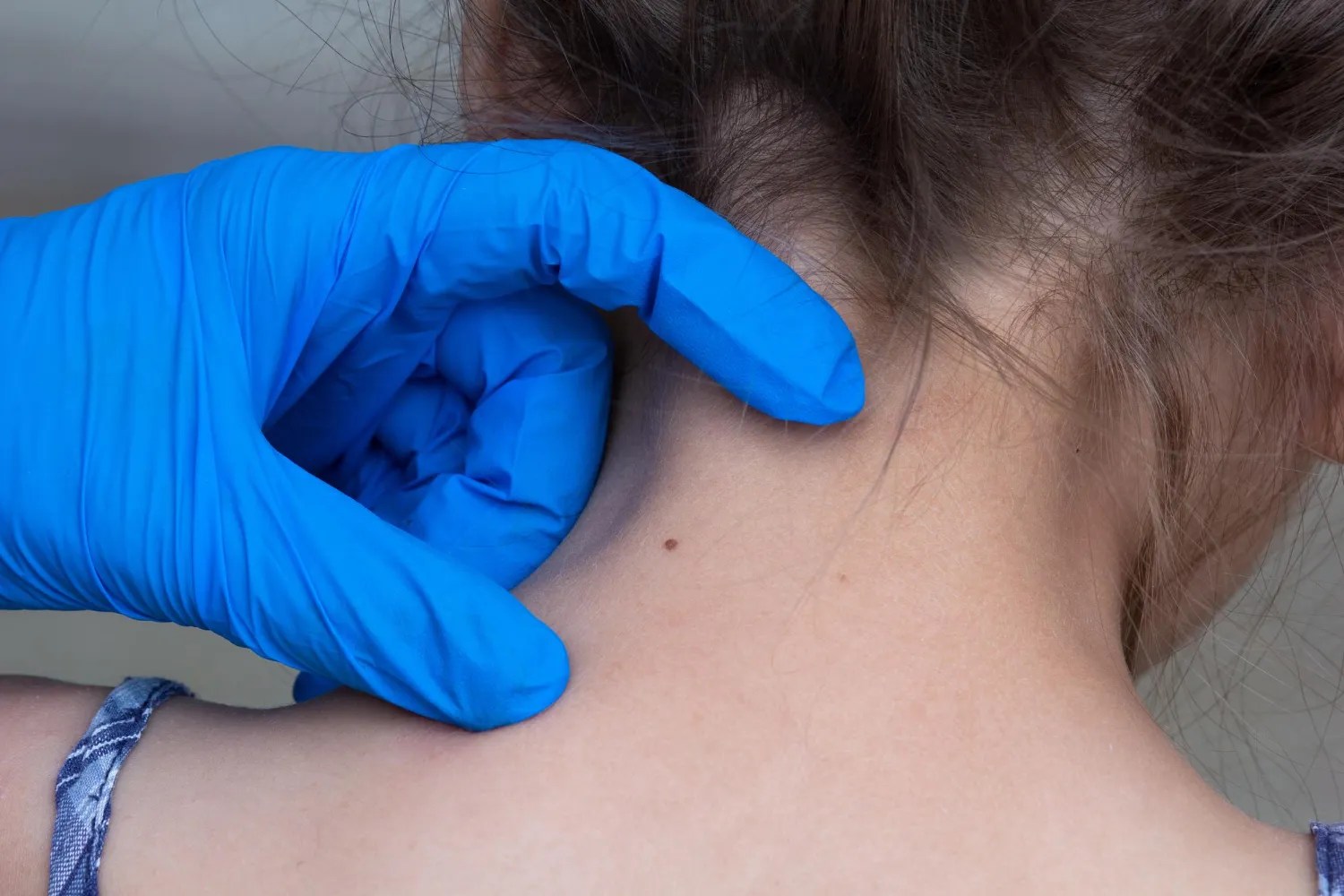 Mole Removal Skyn Care Clinic