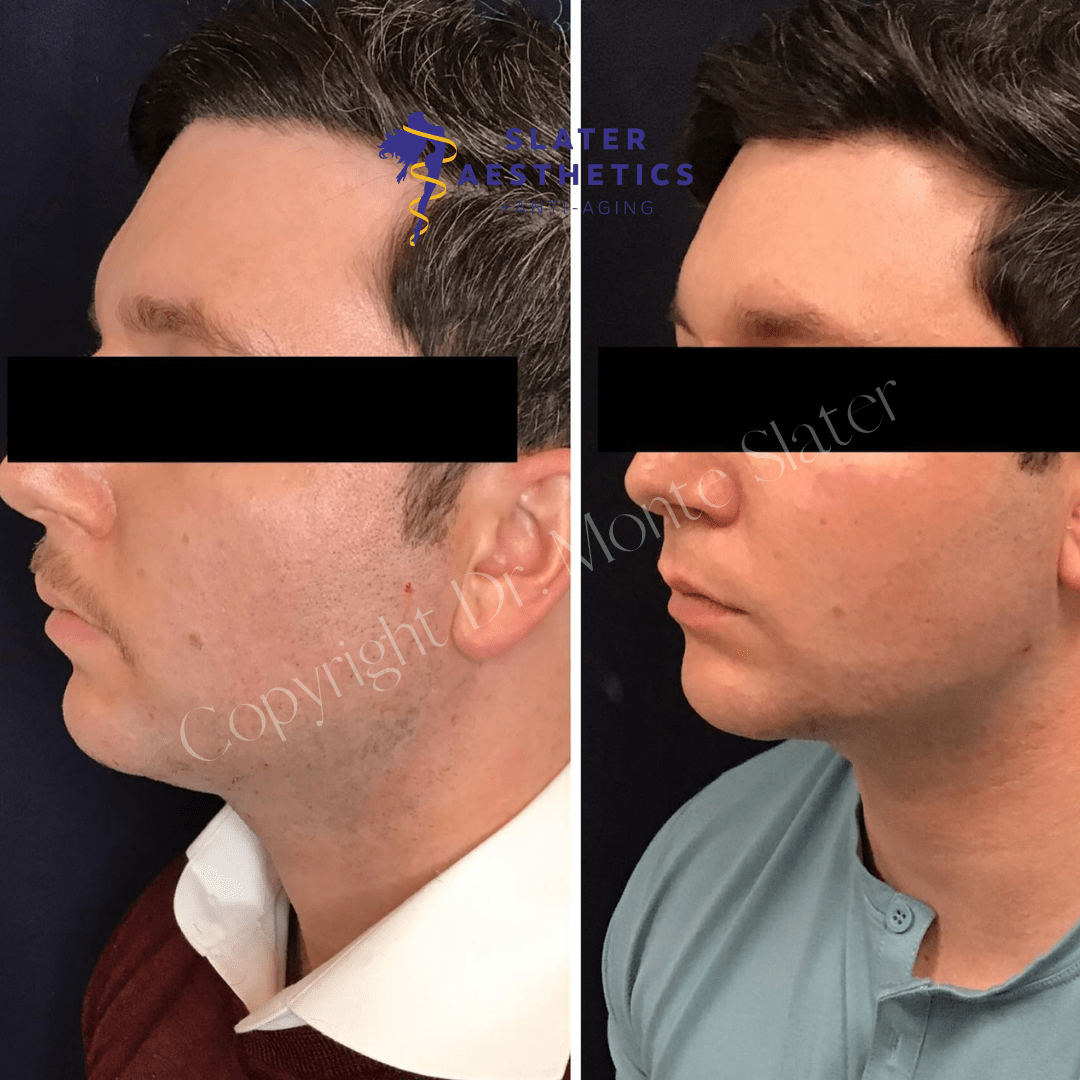 Restylane Filler Slater Aesthetics Atlanta & Warner Robins