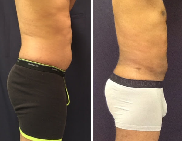 Minimally Invasive Liposuction Sculpt Your Body Without The Downtime