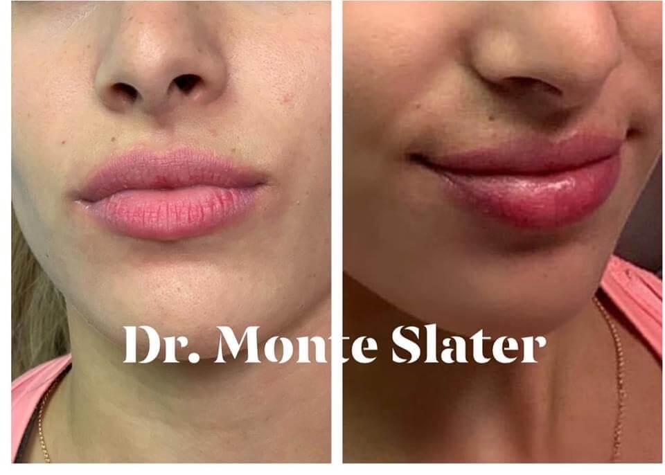 Restylane Kysse Lip Filler Now Available In Atlanta & Warner Robins