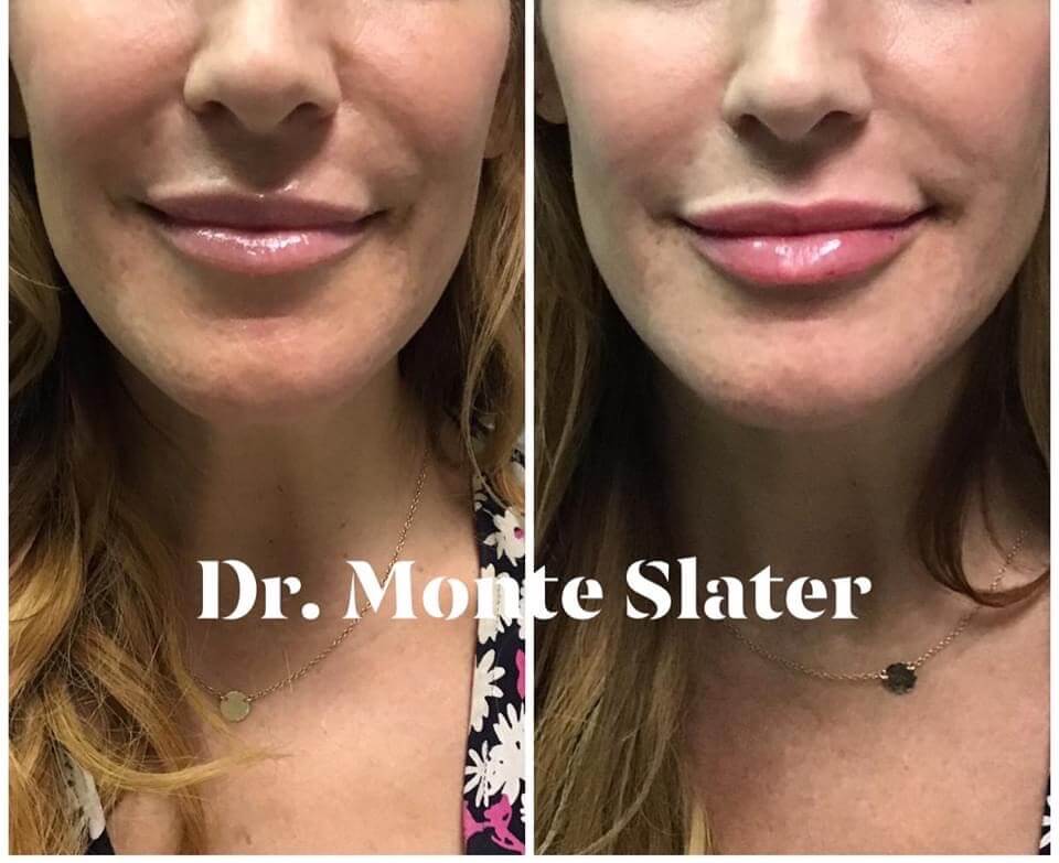 Restylane Kysse Lip Filler Now Available In Atlanta & Warner Robins