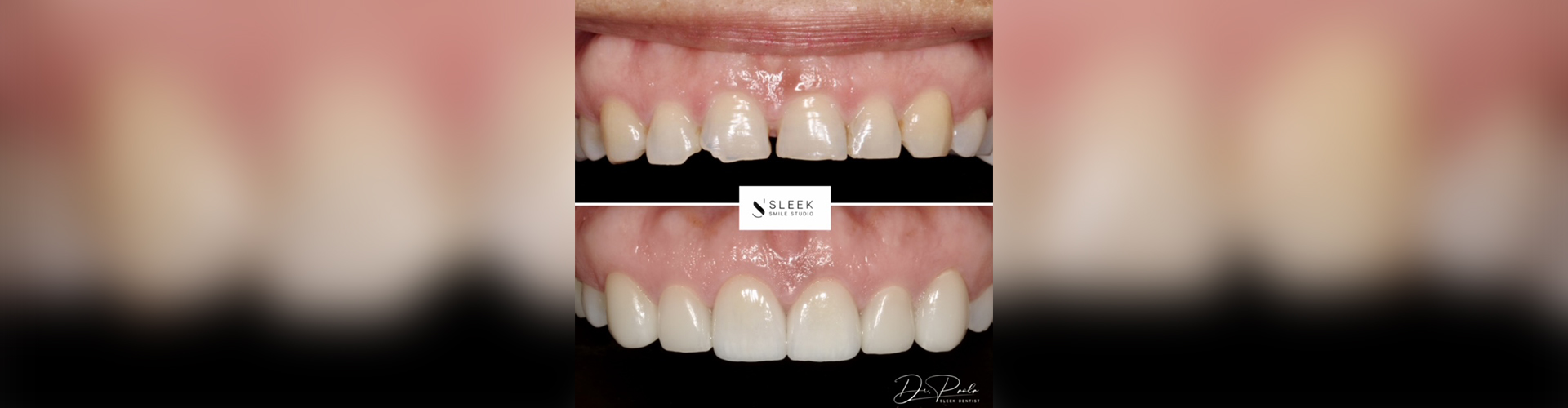 Dental Veneers Near Me in Southampton, PA Sleek Smile Studio