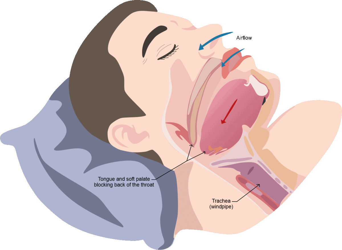 Houston Dental Sleep Therapy Oral Appliance Treatment