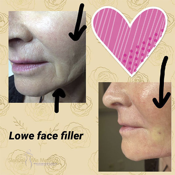 Filler “Parenthesis” “Lower Face” “Chin” Slender Me