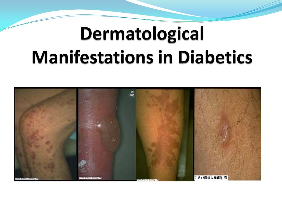 Dermatological Manifestations In Diabetics - Ppt Video Online Download