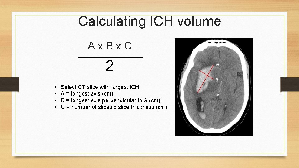 Intracerebral Hemorrhage ICH Krishna Nalleballe MD Acute Management