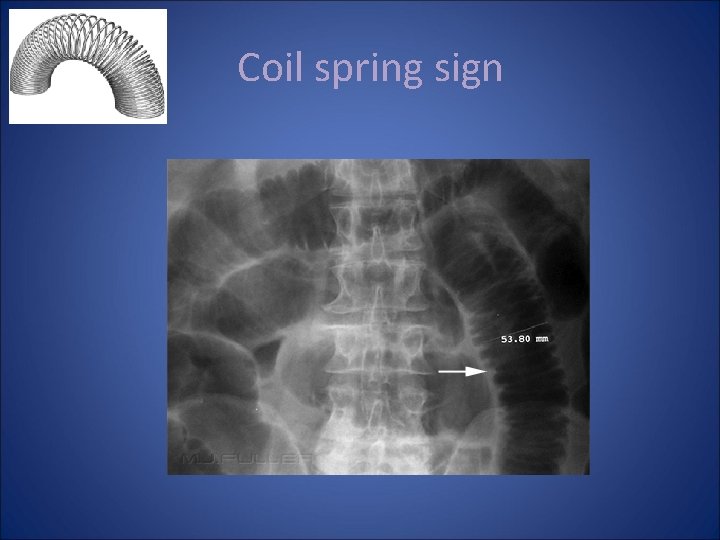 Abdominal Xray Radiological Signs Suzanne OHagan Lightbulb moment