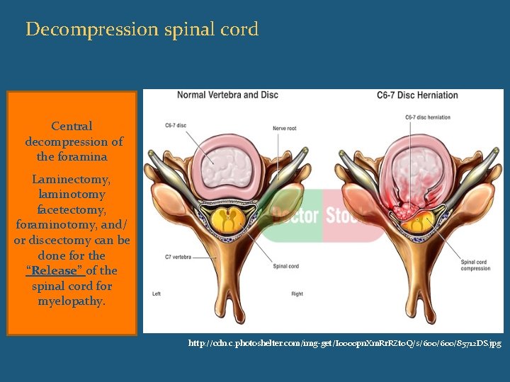 Post Laminectomy Syndrome Icd 9 Captions Todays