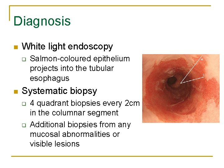 Management of Barretts Esophagus Joint Hospital Surgical Grand