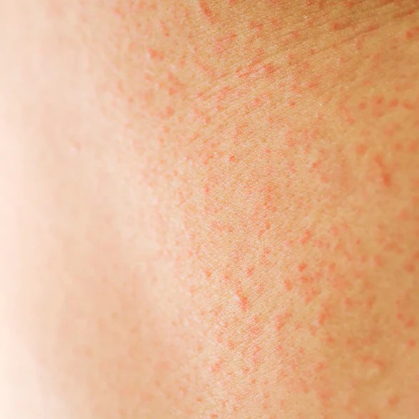 Everything You Need To Know About Contact Dermatitis SLMD Skincare by