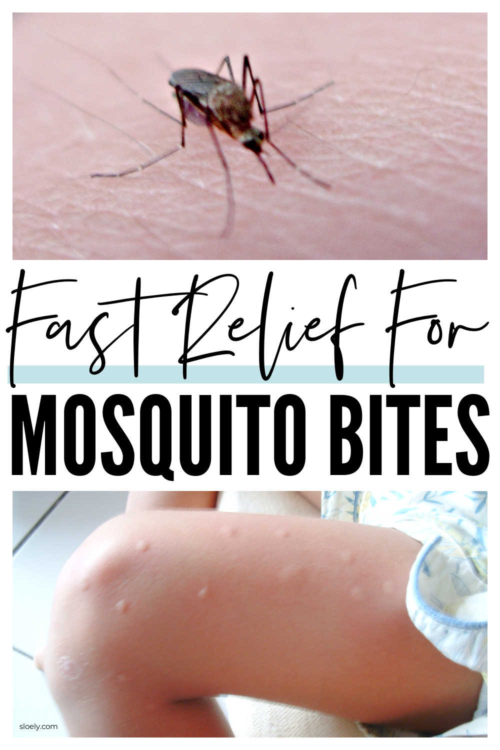 Mosquito Bite Remedies
