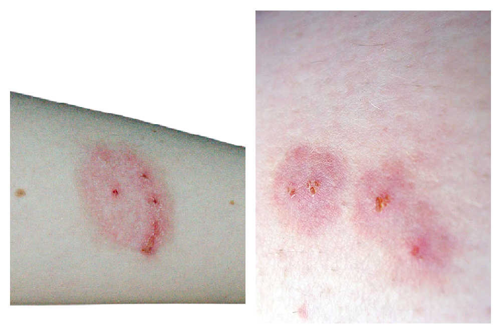 Home Remedies For Bites & Stings