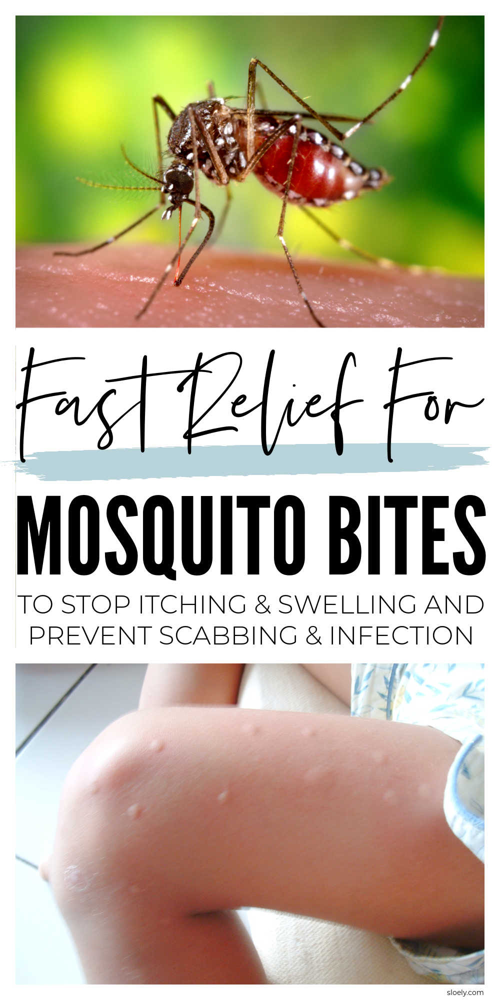 Mosquito Bite Remedies