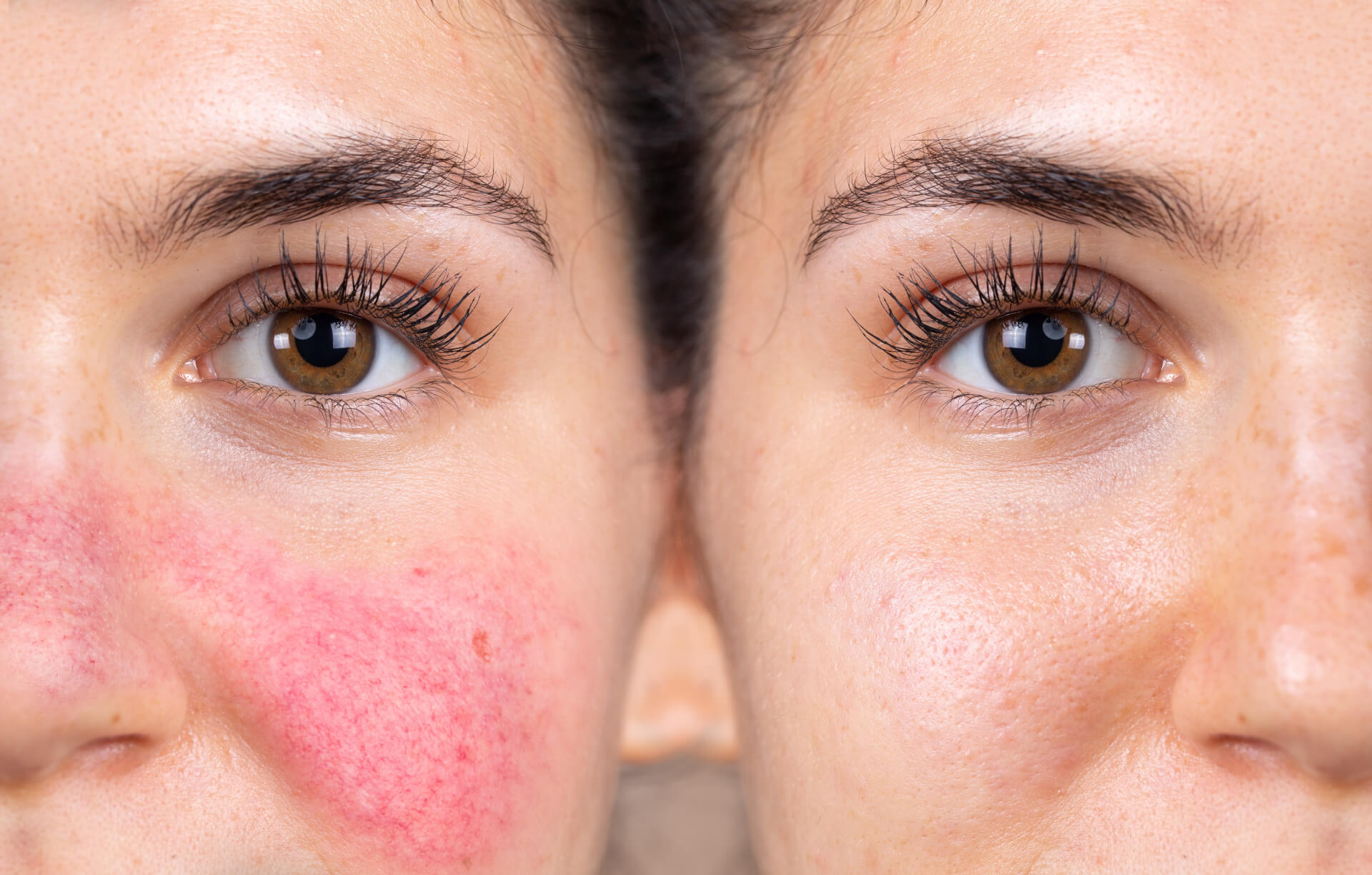 Rosacea Laser Treatment Rochester, Minnesota Slow Coast Spa